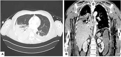 Case Report: Inferior Bilobectomy for Lung Cancer to Allow Weaning From Veno-Venous Extracorporeal Membrane Oxygenation